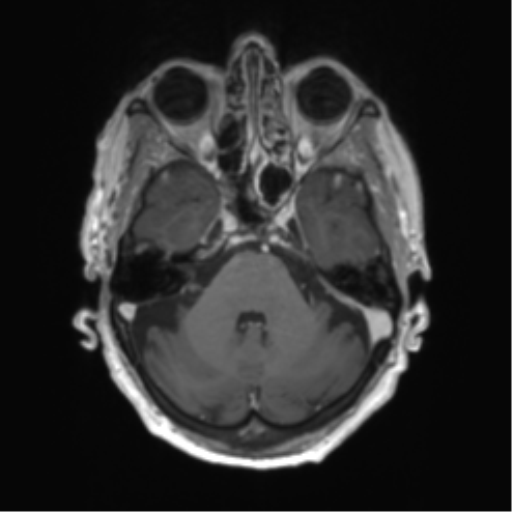 Central neurocytoma (Radiopaedia 65317-74345 Axial T1 C+ 10).png
