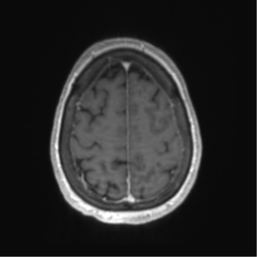 Central neurocytoma (Radiopaedia 65317-74345 Axial T1 C+ 50).png