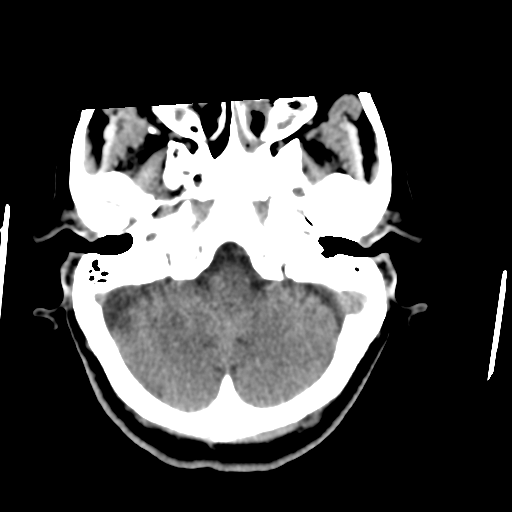Central neurocytoma (Radiopaedia 65317-74346 Axial non-contrast 10).png
