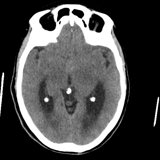 Central neurocytoma (Radiopaedia 65317-74346 Axial non-contrast 22).png