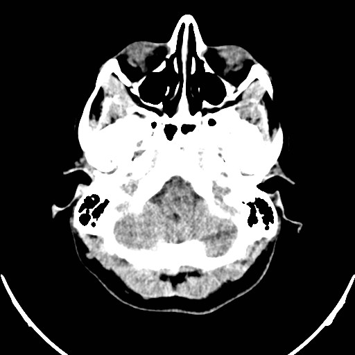 Central neurocytoma (Radiopaedia 84497-99871 Axial non-contrast 4).jpg