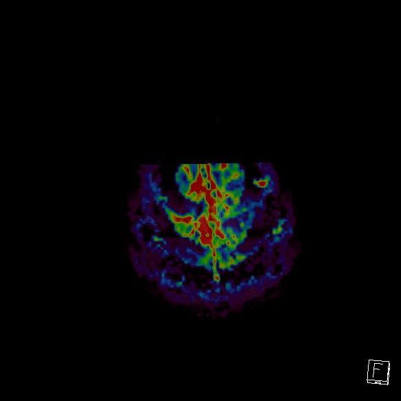 Central neurocytoma (Radiopaedia 84497-99872 Axial Perfusion 11).jpg