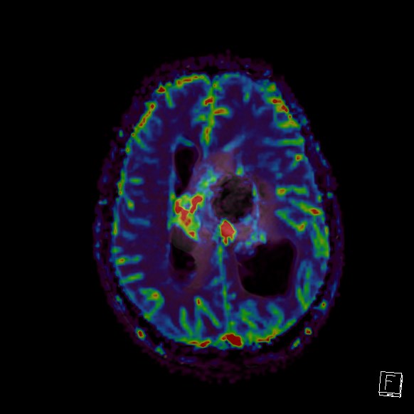 Central neurocytoma (Radiopaedia 84497-99872 Axial Perfusion 115).jpg