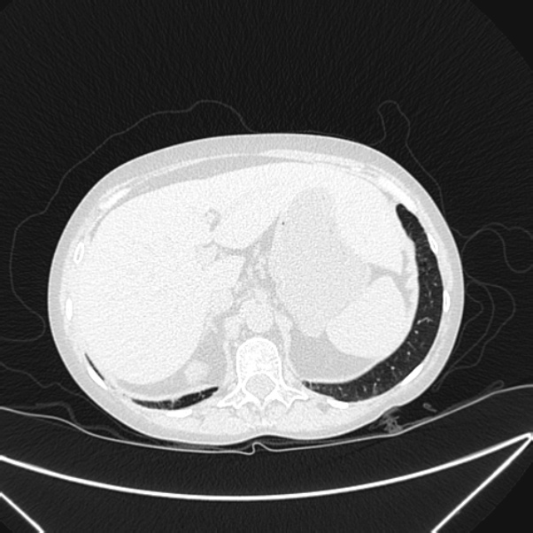 Centrilobular pulmonary emphysema (Radiopaedia 24495-24789 Axial lung window 88).jpg