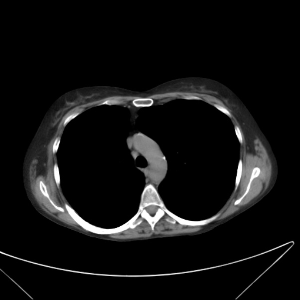Centrilobular pulmonary emphysema (Radiopaedia 24495-24789 Axial non-contrast 17).jpg