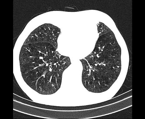 Centrilobular pulmonary emphysema (Radiopaedia 62468-70718 Axial lung window 55).jpg