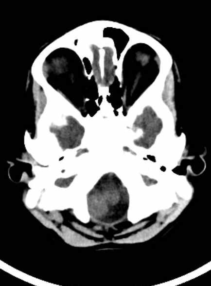 Cerebellar abscess (Radiopaedia 73727-84527 Axial non-contrast 23).jpg