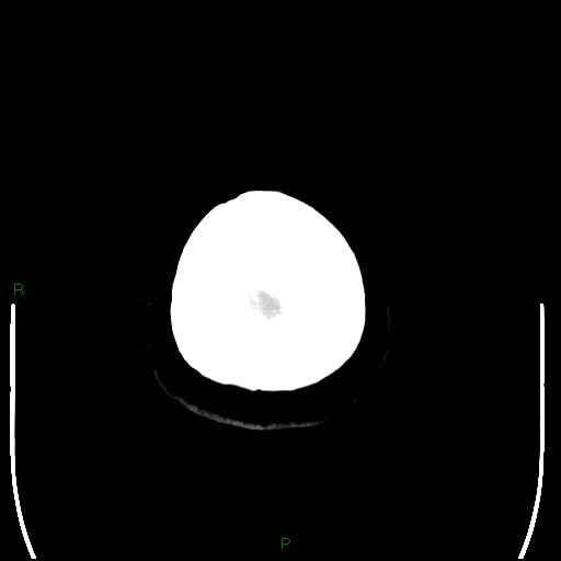 Cerebellar abscess (Radiopaedia 78135-90671 Axial non-contrast 110).jpg