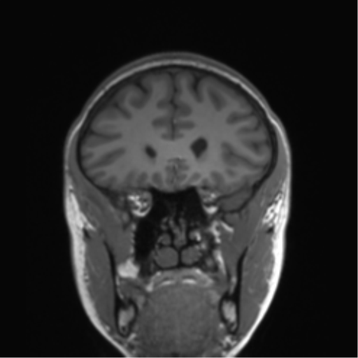 Cerebellar agenesis with hypoplastic pons (pontocerebellar hypoplasia) (Radiopaedia 57224-64138 Coronal T1 66).png