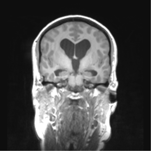 Cerebellar ependymoma complicated by post-operative subdural hematoma (Radiopaedia 83322-97736 Coronal T1 26).png