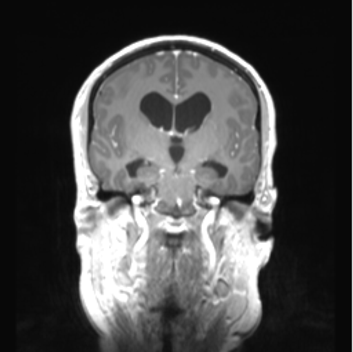 Cerebellar ependymoma complicated by post-operative subdural hematoma (Radiopaedia 83322-97736 Coronal T1 C+ 27).png