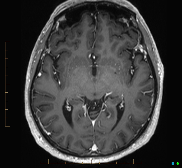 Cerebellar gangliocytoma (Radiopaedia 65377-74422 Axial T1 C+ 59).jpg