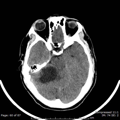 Cerebellar hemangioblastoma (Radiopaedia 52360-58258 Axial non-contrast 60).jpg