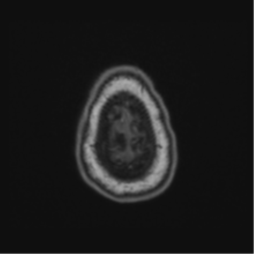 Cerebellar hemangioblastomas and pituitary adenoma (Radiopaedia 85490-101176 Axial T1 69).png