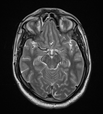 File:Cerebellar hemangioblastomas and pituitary adenoma (Radiopaedia 85490-101176 Axial T2 15).png
