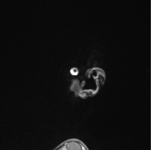 Cerebellar hemangioblastomas and pituitary adenoma (Radiopaedia 85490-101176 Sagittal T1 14).png