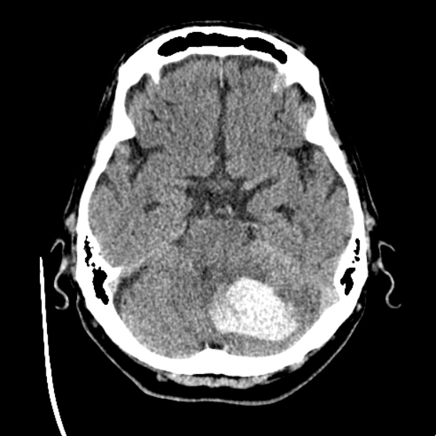 Cerebellar hemorrhage (Radiopaedia 27193-27359 Axial non-contrast 15).jpg