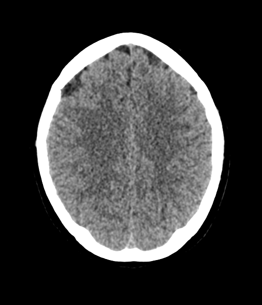 File:Cerebellar metastases - colorectal adenocarcinoma (Radiopaedia 40947-43652 Axial non-contrast 46).png