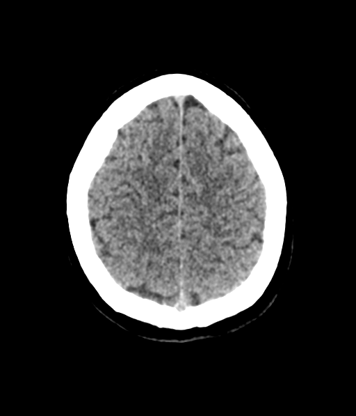 Cerebellar metastases - colorectal adenocarcinoma (Radiopaedia 40947-43652 Axial non-contrast 55).png
