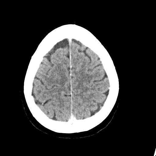 Cerebellar metastasis (Radiopaedia 54578-60812 Axial C+ 41).png