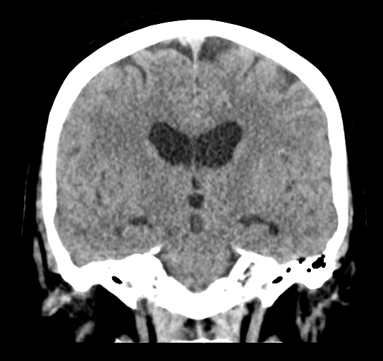 Cerebellar metastasis (Radiopaedia 54578-60812 Coronal non-contrast 29).png