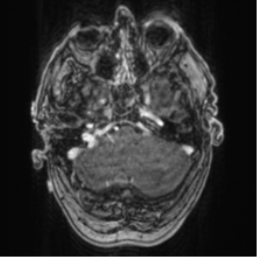 Cerebellar metastasis from lung adenocarcinoma (Radiopaedia 86690-102829 Axial T1 C+ 18).png