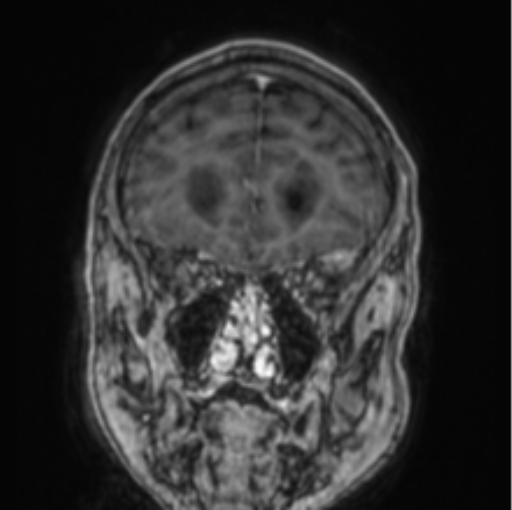 Cerebellar metastasis from lung adenocarcinoma (Radiopaedia 86690-102829 Coronal T1 C+ 75).png