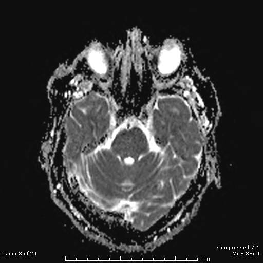 File:Cerebellar strokes due to intracranial giant cell arteritis (Radiopaedia 68799-81713 Axial ADC 8).jpg