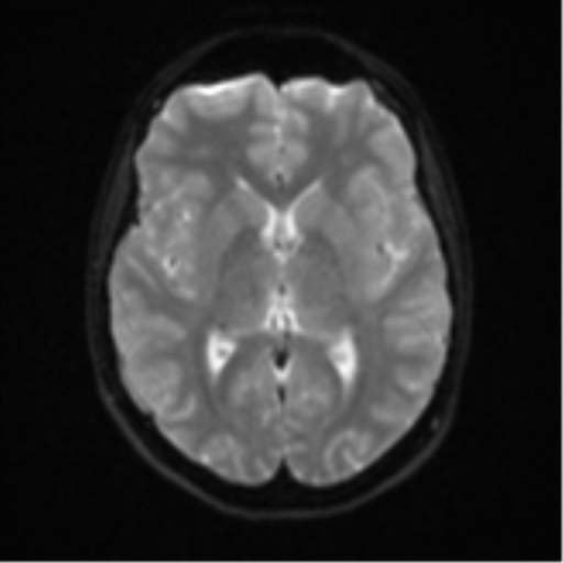 Cerebellar tuberculomas (Radiopaedia 46939-51472 Axial DWI 15).png