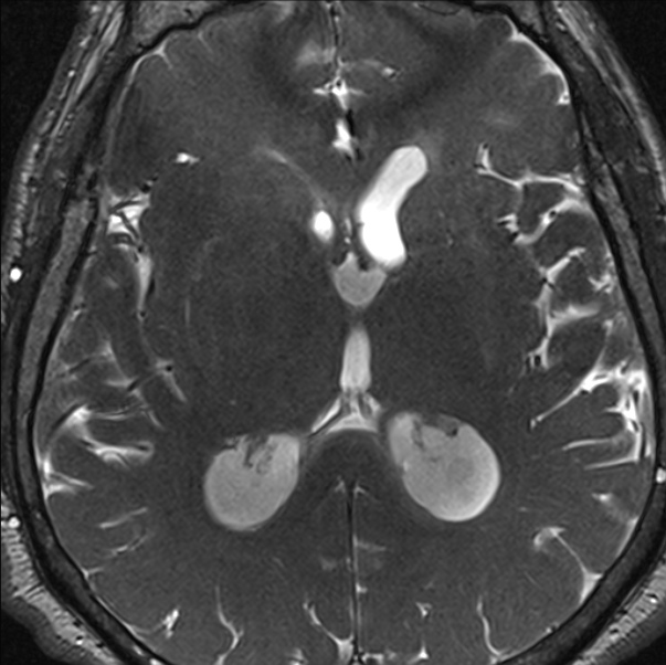 Cerebellopontine angle meningioma (Radiopaedia 24459-24764 I 58).jpg