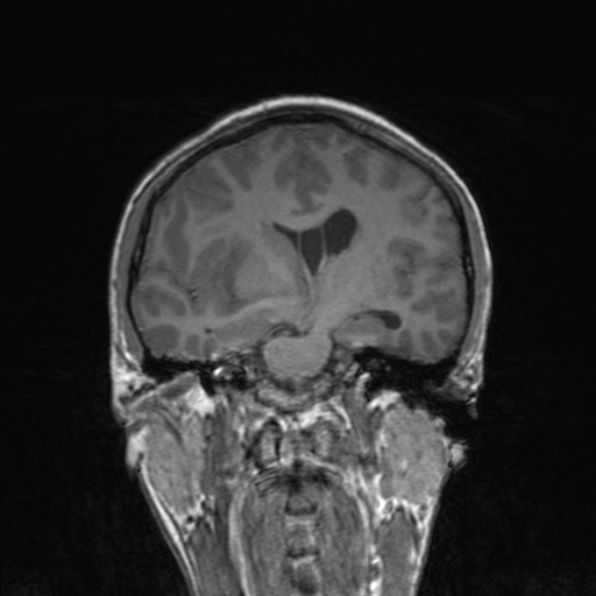 File:Cerebral abscess (Radiopaedia 24212-24478 Coronal T1 111).jpg