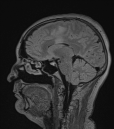 Cerebral abscess from pulmonary arteriovenous malformation (Radiopaedia 86275-102291 Sagittal FLAIR 41).png