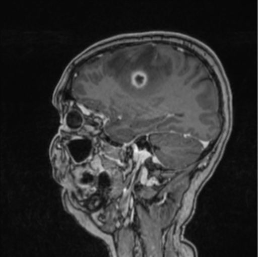 Cerebral abscess from pulmonary arteriovenous malformation (Radiopaedia 86275-102291 Sagittal T1 C+ 53).png