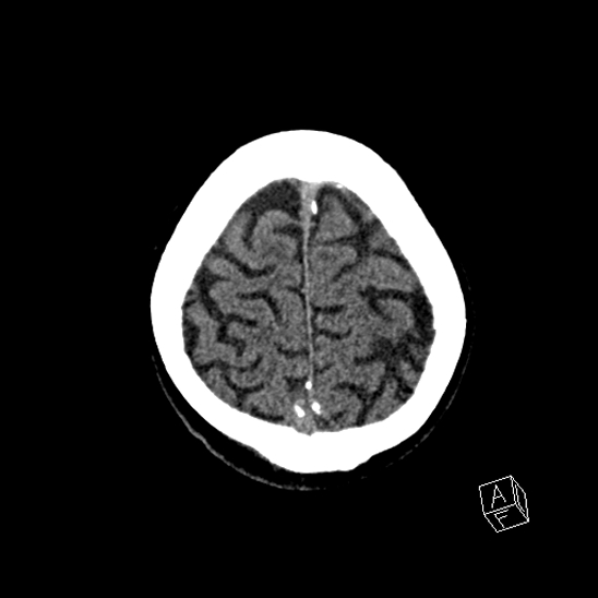 Cerebral abscess with ventriculitis (Radiopaedia 78965-91876 Axial non-contrast 43).jpg