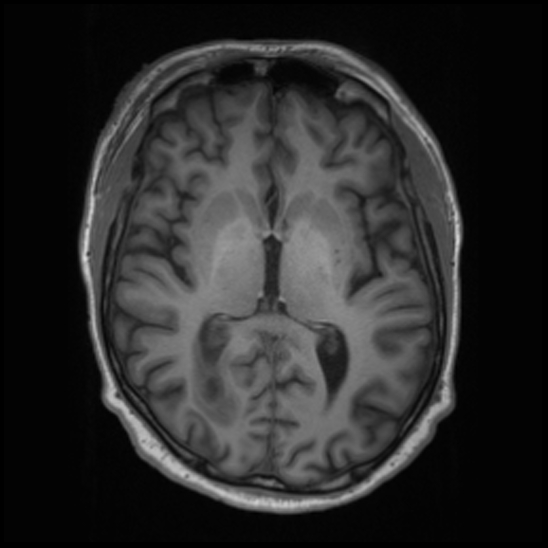File:Cerebral abscess with ventriculitis (Radiopaedia 78965-91878 Axial T1 25).jpg