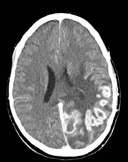 Cerebral abscesses (Radiopaedia 70458-80568 Axial Contrast 38).jpg