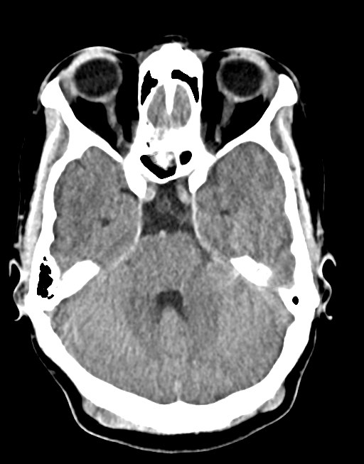 Cerebral abscesses (Radiopaedia 70458-80568 Axial non-contrast 22).jpg