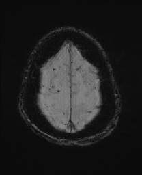 Cerebral amyloid angiopathy-related inflammation (Radiopaedia 74836-85849 Axial SWI 62).jpg