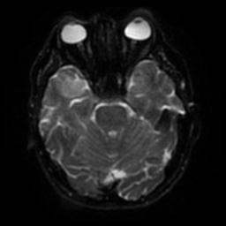 Cerebral amyloid angiopathy (Radiopaedia 28698-28978 Axial DWI 37).jpg