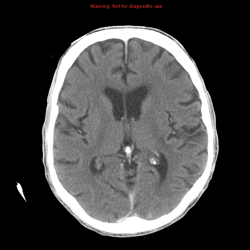 File:Cerebral and orbital tuberculomas (Radiopaedia 13308-13310 B 16).jpg