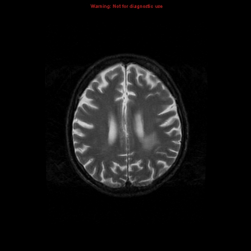 File:Cerebral and orbital tuberculomas (Radiopaedia 13308-13311 Axial T2 15).jpg