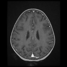 File:Cerebral and spinal tuberculosis (Radiopaedia 90489-107837 Axial T1 C+ 131).jpg