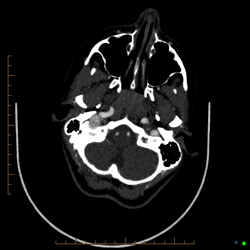 Cerebral arteriovenous malformation (AVM) (Radiopaedia 78162-90706 Axial CTA 56).jpg