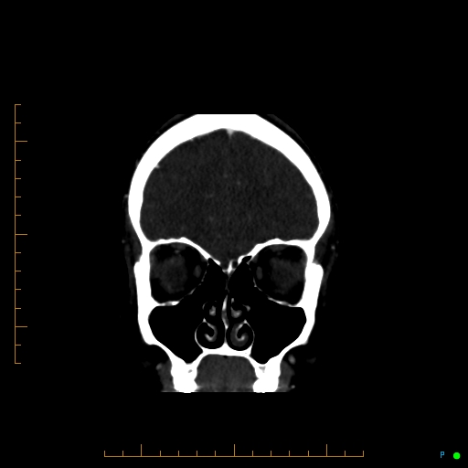 Cerebral arteriovenous malformation (AVM) (Radiopaedia 78162-90706 Coronal CTA 82).jpg