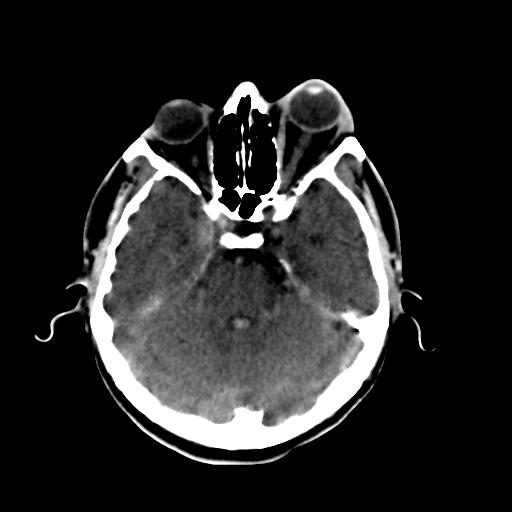 Cerebral arteriovenous malformation (Radiopaedia 28518-28759 Axial non-contrast 22).jpg