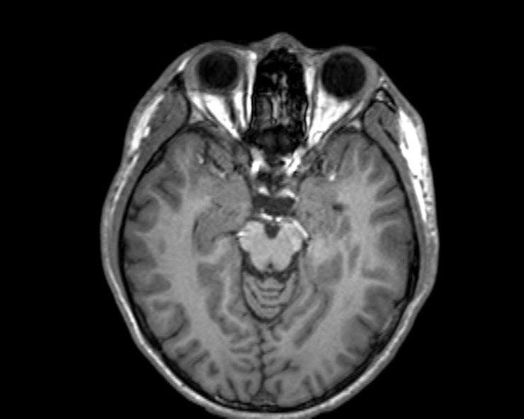 Cerebral arteriovenous malformation (Radiopaedia 30198-30813 Axial T1 38).jpg