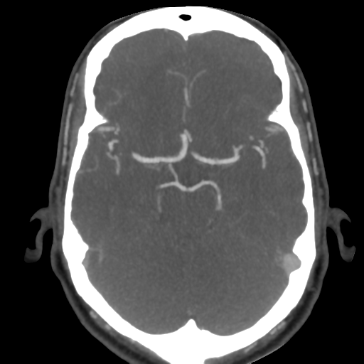 Cerebral arteriovenous malformation (Radiopaedia 39259-41505 AX CEREBRAL CTA 21).png