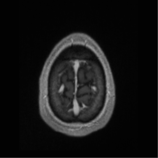 File:Cerebral arteriovenous malformation (Radiopaedia 55798-62372 Axial T1 C+ 72).png