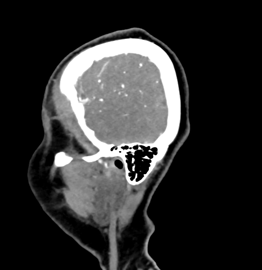Cerebral arteriovenous malformation (Radiopaedia 73830-84645 D 82).jpg
