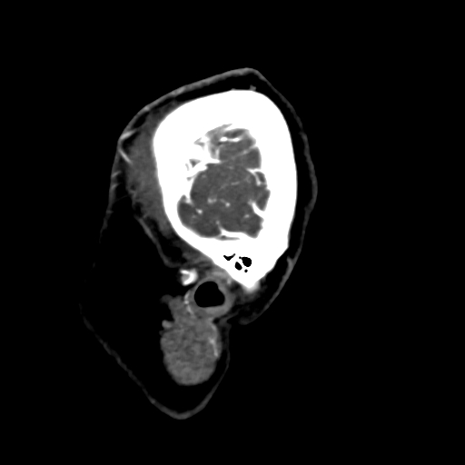 Cerebral arteriovenous malformation (Radiopaedia 73830-84645 Sagittal C+ delayed 86).jpg